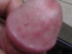 包皮红疙瘩